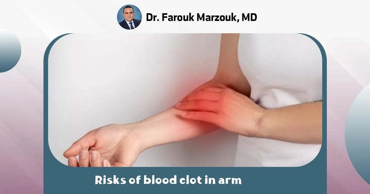 Blood Clot In Arm Symptoms, Treatment, And Prevention