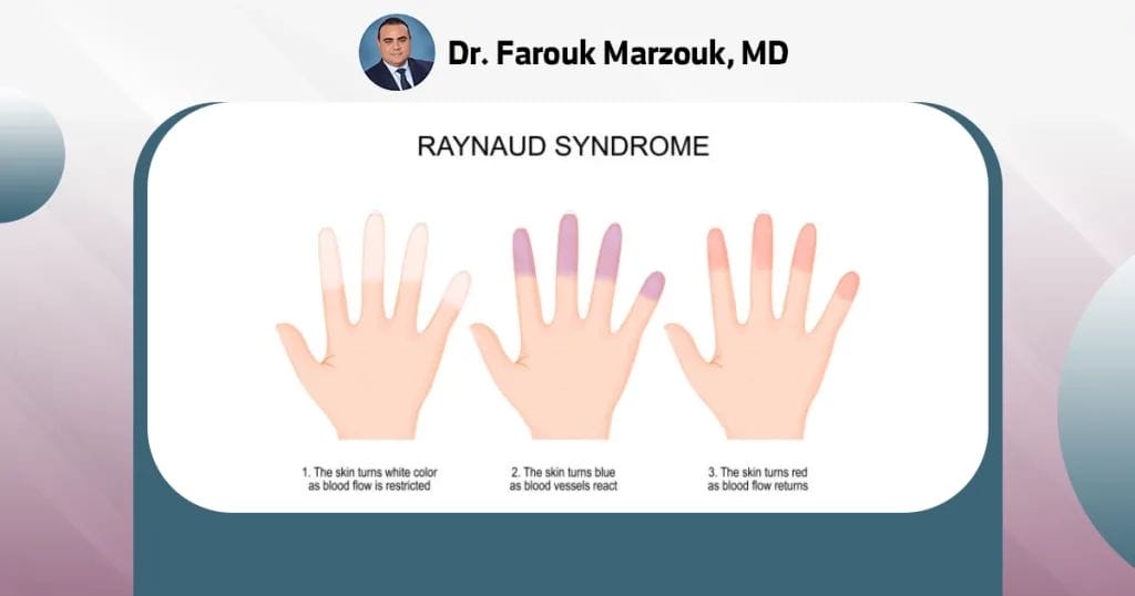 What is the life expectancy of Raynaud's syndrome?