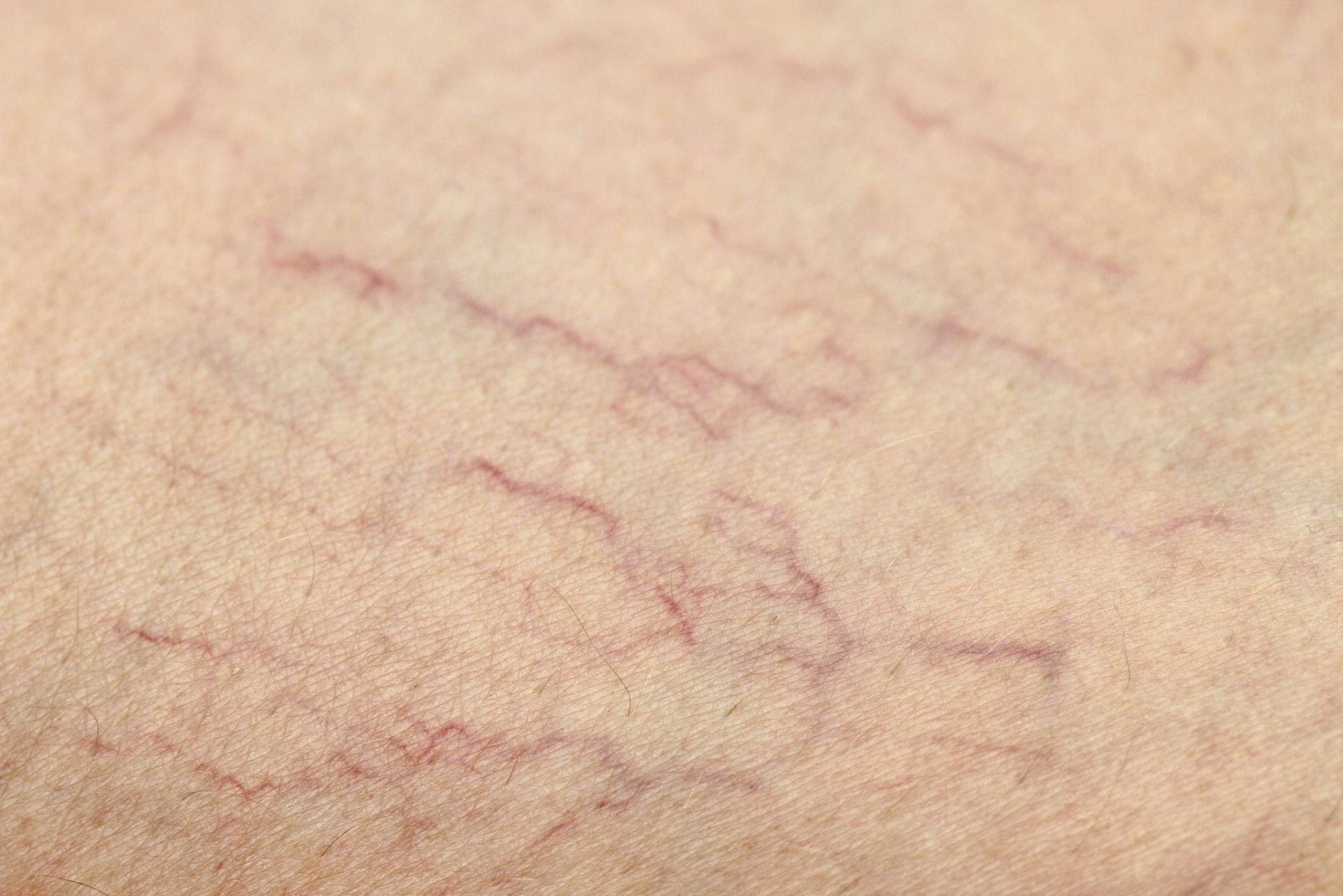 how to cure spider veins with vinegar