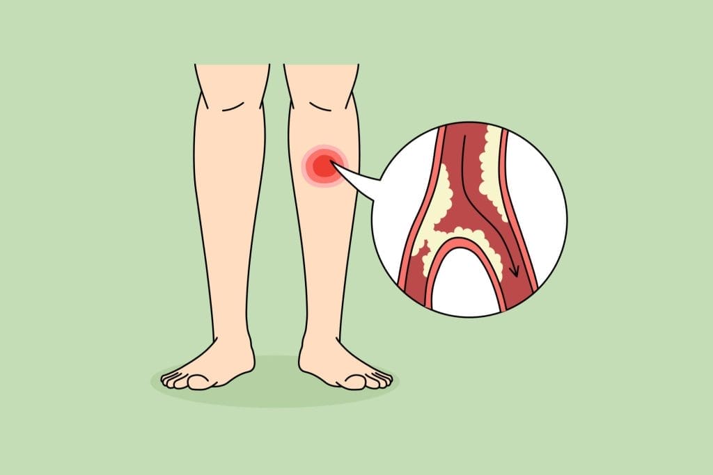 Blockage of arteries in legs