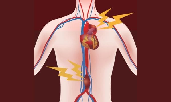 How is aortic aneurysm diagnosed? 