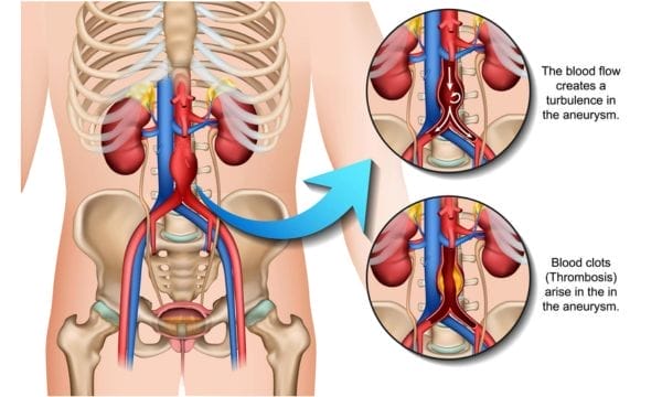 How is aortic aneurysm treated? 