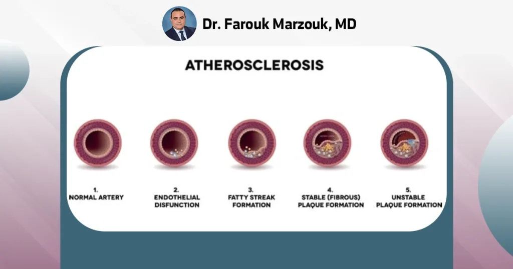 Complication of atherosclerosis