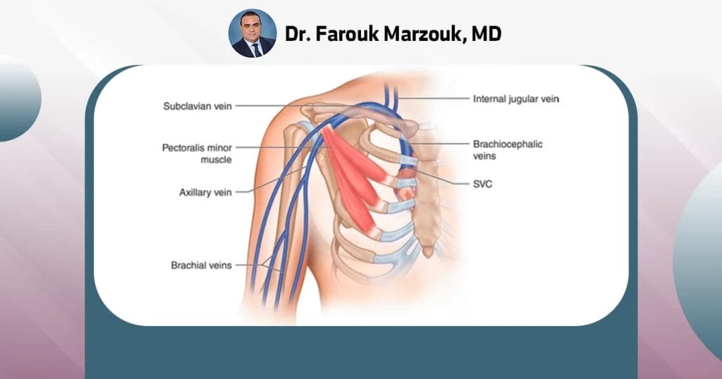 What anticoagulation for axillary vein thrombosis?