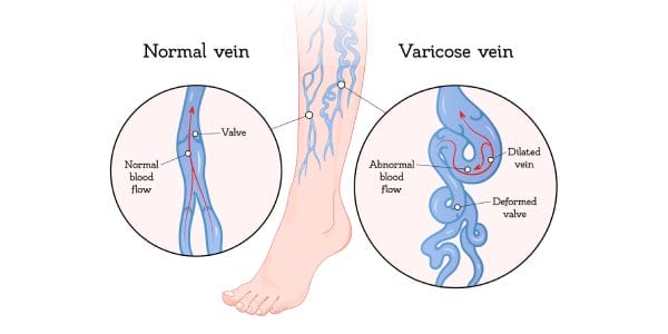 Testicular varicose veins
