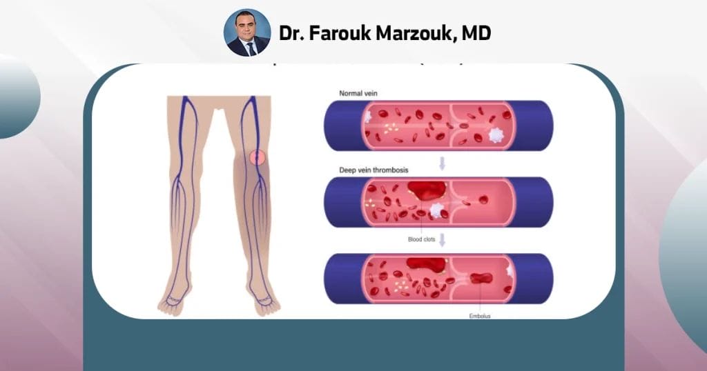 What is the most common cause of chronic venous insufficiency?
