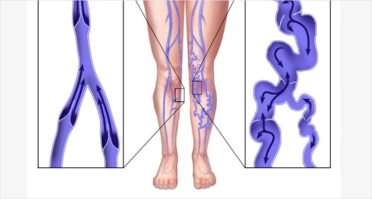 Spider vein therapy - How long does sclerotherapy last?