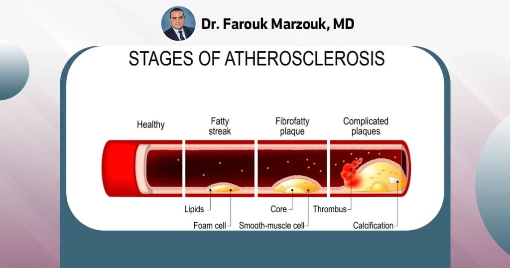Treatment of atherosclerosis