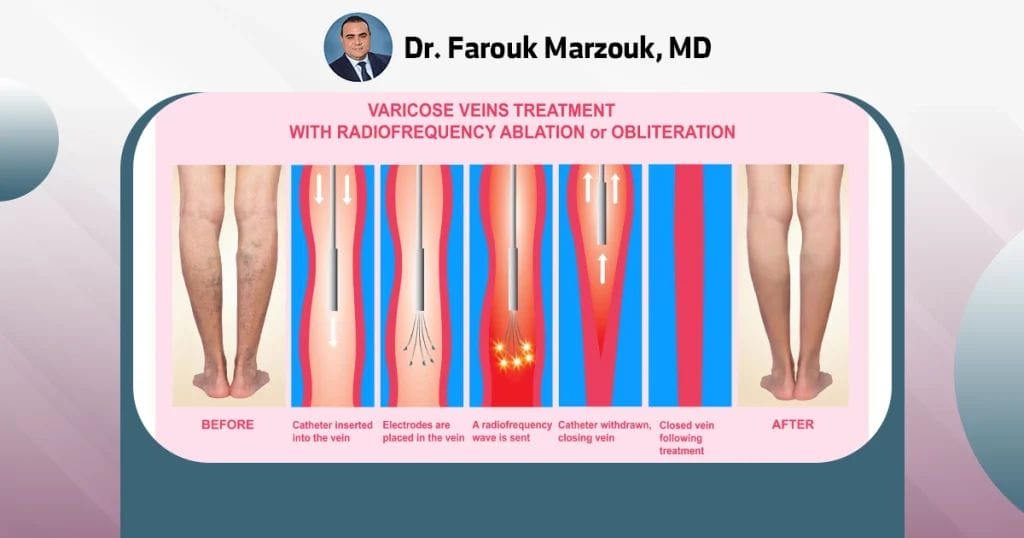 What is the best treatment for spider veins? Spider vein therapy