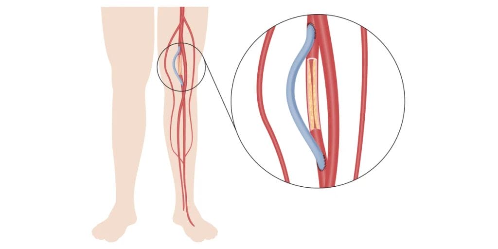 What are the problems with vascular grafts? Vascular grafting