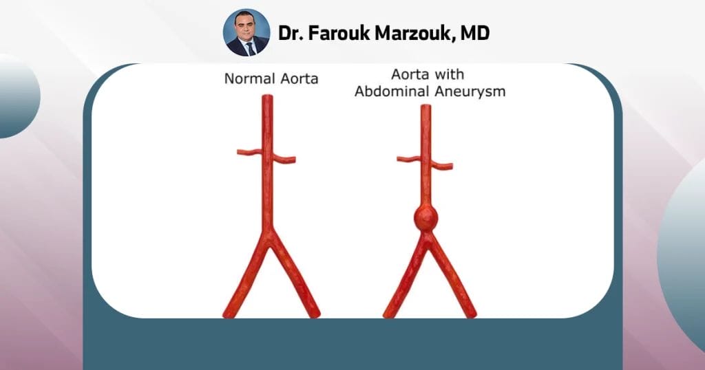 What is the main cause of aortic aneurysm?