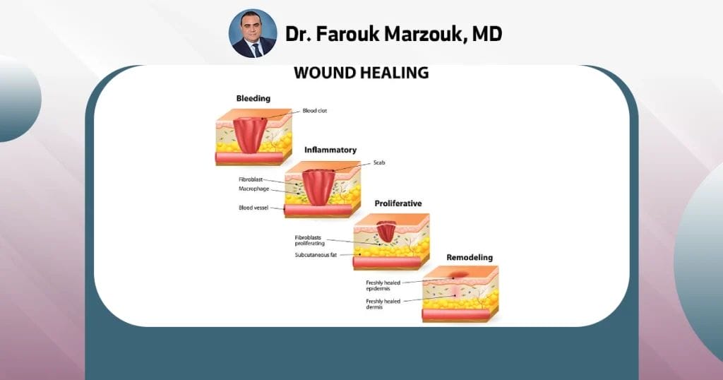 What is the 4 stages of wound healing?