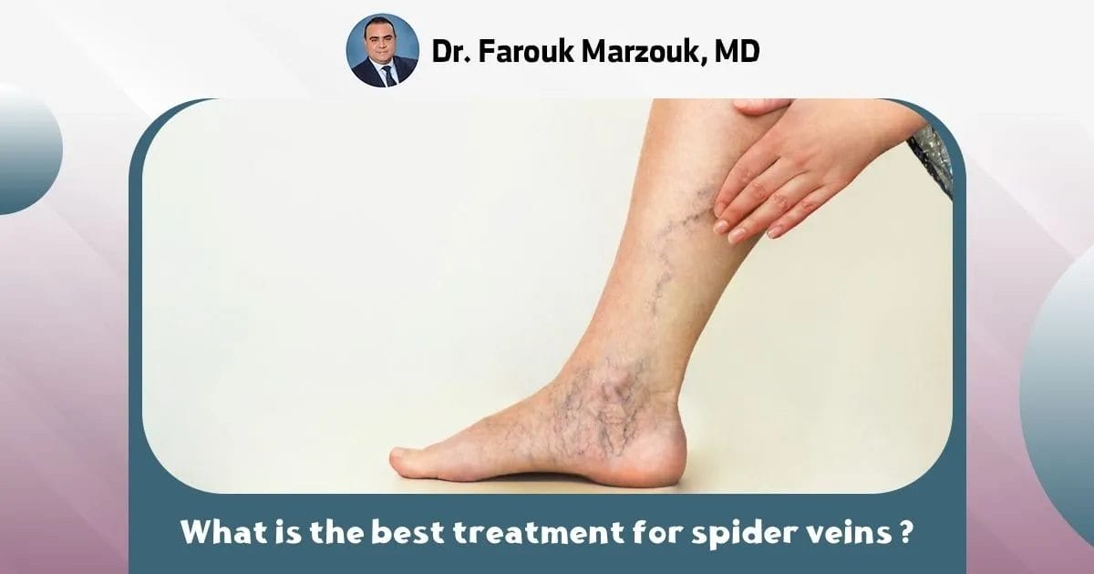Treatment of spider veins | What is the best treatment for spider veins ?