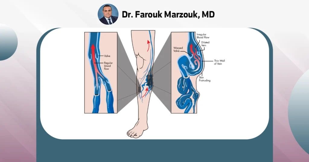 What are the risks of spider vein treatments?