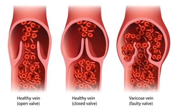 What is stage 3 of chronic venous insufficiency? 