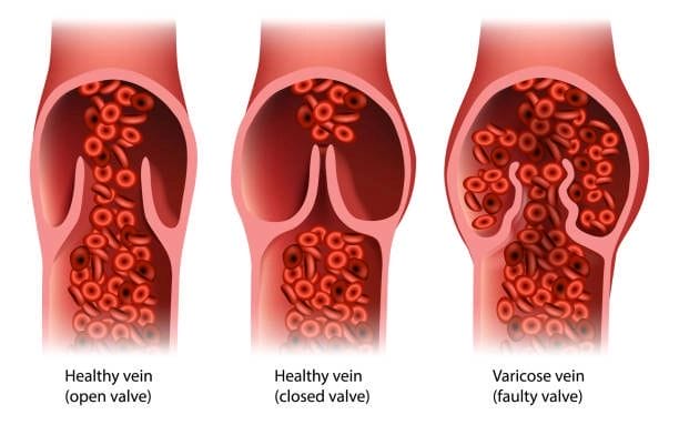 What is stage 3 of chronic venous insufficiency?
