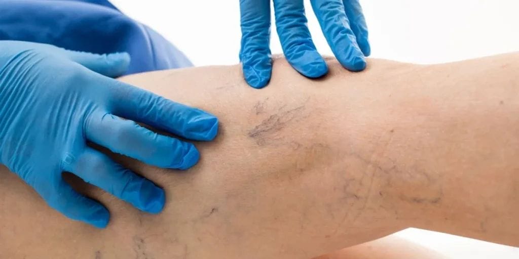 Treatment of spider veins | What is the best treatment for spider veins ? how can you get rid of spider veins naturally
