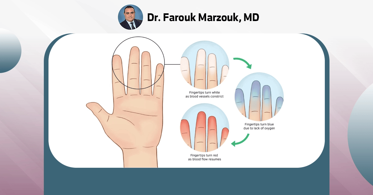 How to Manage Raynaud's Syndrome: Tips and Strategies