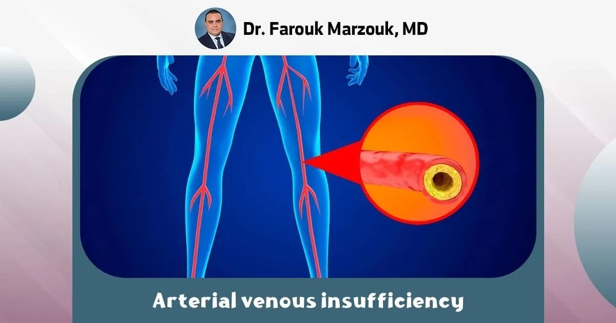 Arterial venous insufficiency | What is the cause of acute arterial insufficiency?