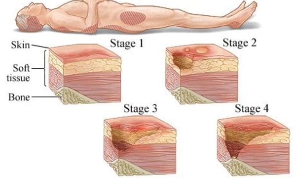 Healing from Ulcers Made Simple: Top Methods Revealed