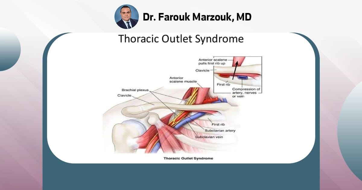 Thoracic outlet syndrome - Symptoms and causes