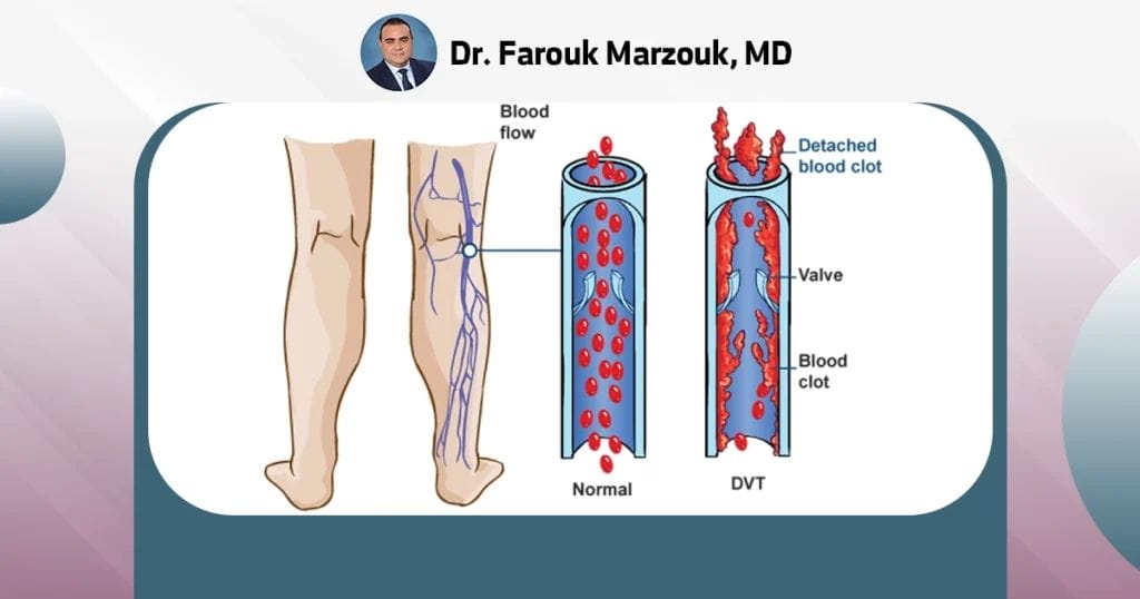 Expert Advice: Recognizing a Blood Clot in the Forearm
