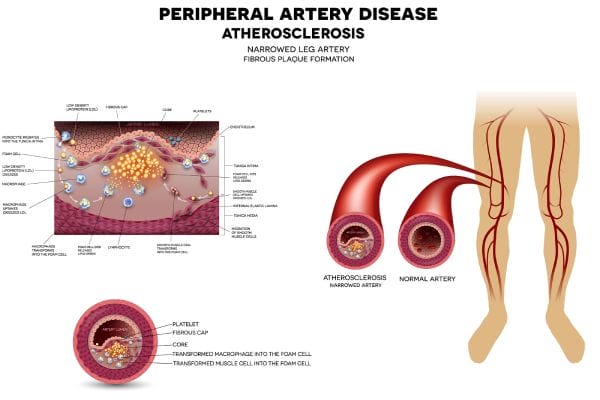 Complication of atherosclerosis