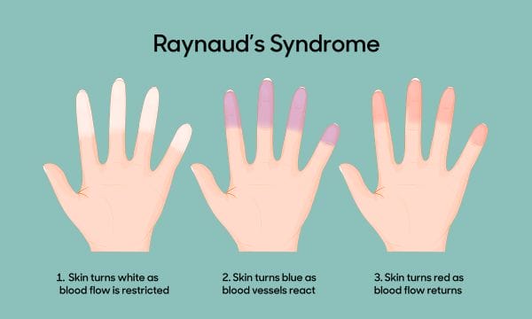 How to Manage Raynaud's Syndrome 5 Common Triggers of Raynaud's Syndrome to Avoid
