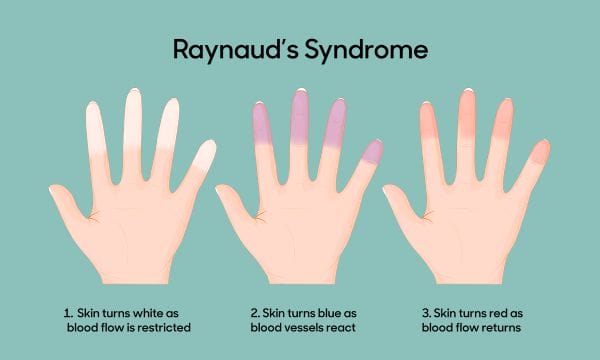 5 Common Triggers of Raynaud's Syndrome to Avoid