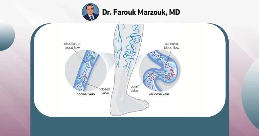 Which treatment is best for varicose veins?