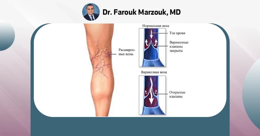 Can you stop varicose veins?
