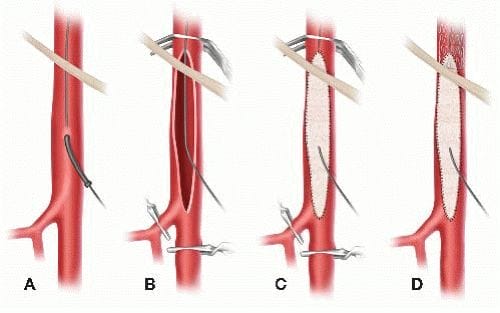 What causes popliteal artery aneurysm? 