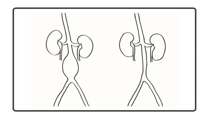 4 cm Aortic Aneurysm