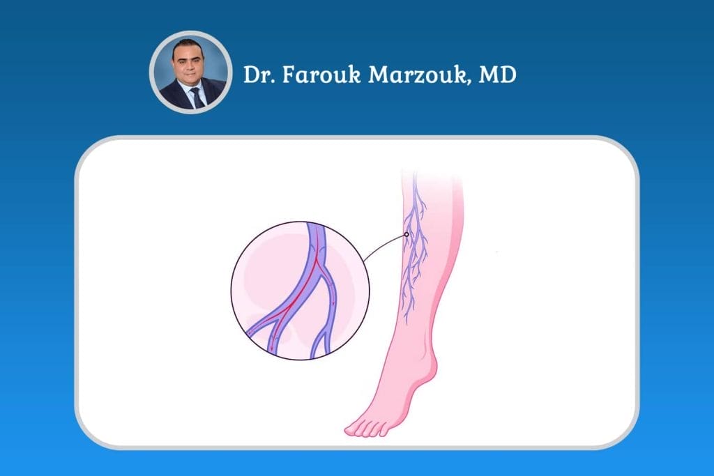 What Is the Best Treatment for Venous Insufficiency?