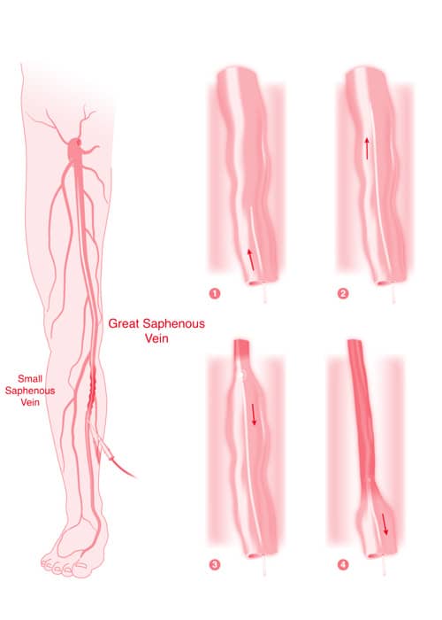 Endovenous Laser Therapy Vein Ablation long-term side effects