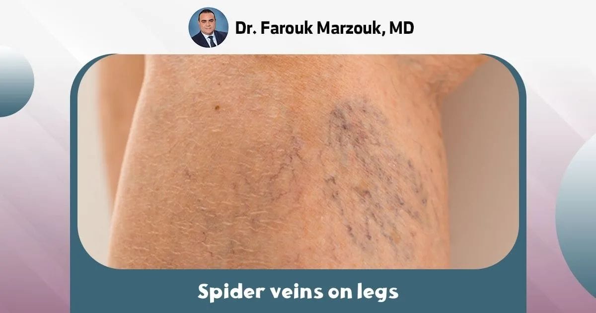 spider veins on legs