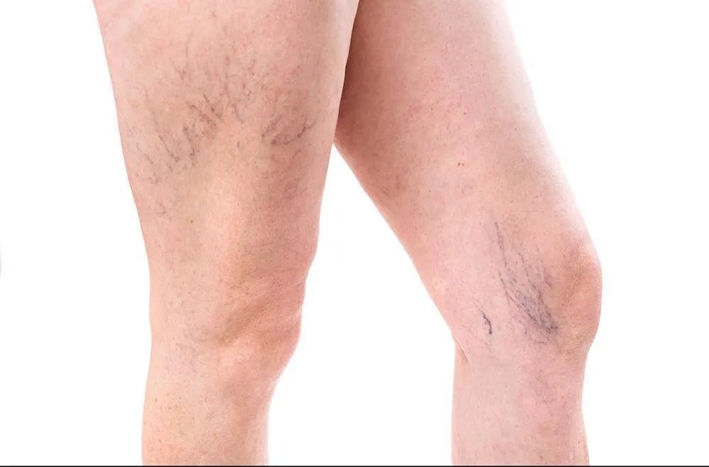 spider veins on legs spider veins on legs