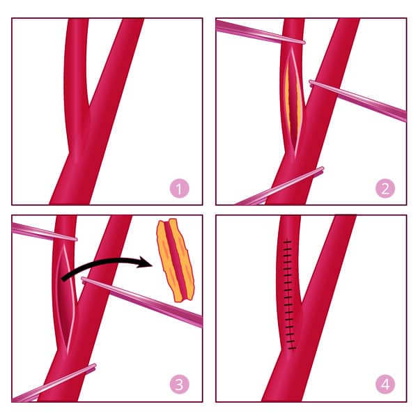 Lifestyle Changes to Improve Life Expectancy After Carotid Endarterectomy