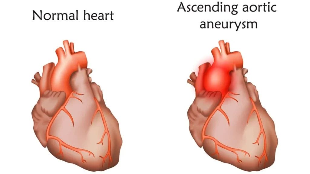 Which Is Worse: Ascending or Descending Aortic Aneurysm? Ascending Aortic Aneurysm