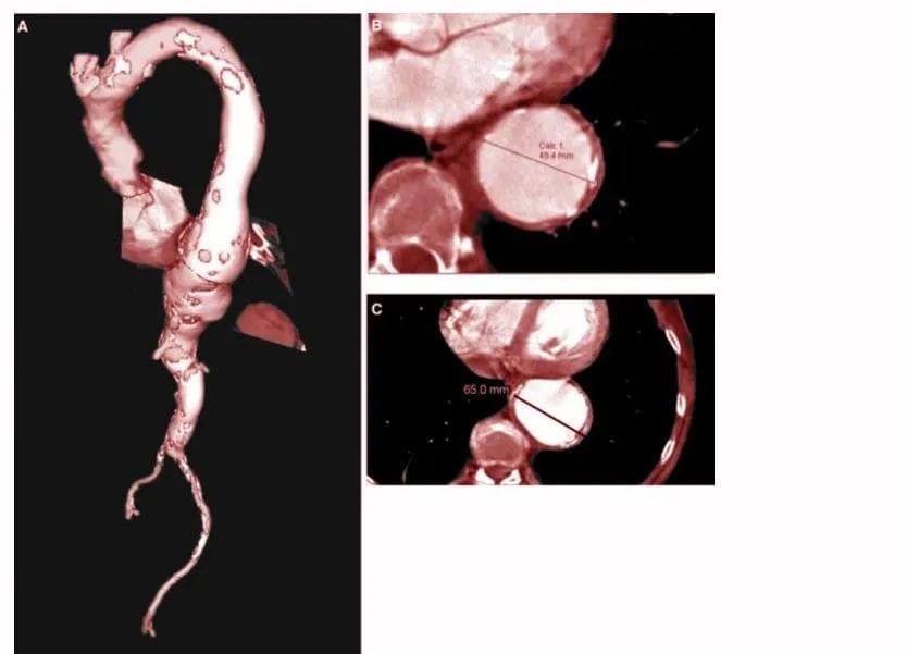 descending aortic aneurysm