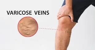 Best exercises for varicose veins