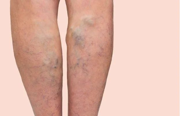 Surgery for varicose veins