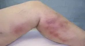 Understanding trapped blood after vein ablation Symptoms to be watched for