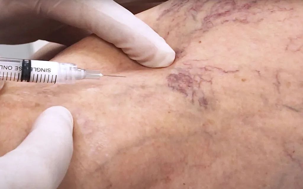 Understanding trapped blood after vein ablation Treatment Options for Trapped Blood