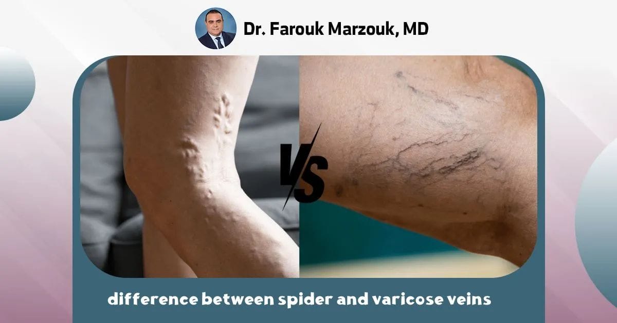 The difference between spider and varicose veins