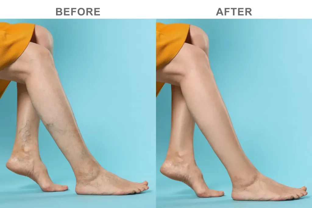 Varicose Veins Laser Treatment Before and After Pain During Laser Varicose Vein Removal