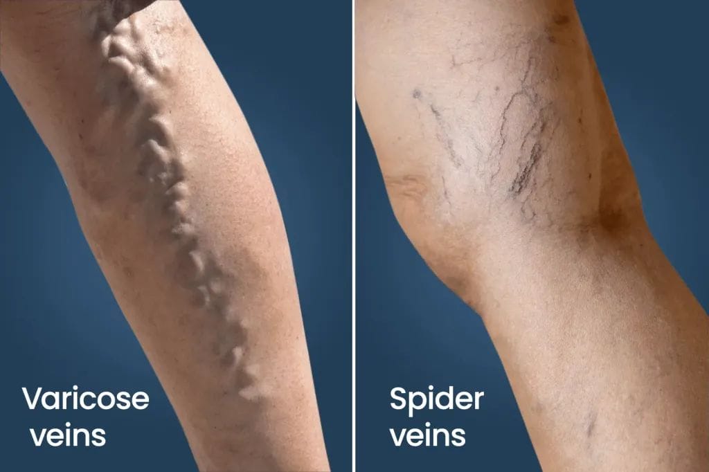 Spider Veins vs Varicose Veins: Differences, and Treatment Spider veins vs Varicose Veins _ The Difference between the Two