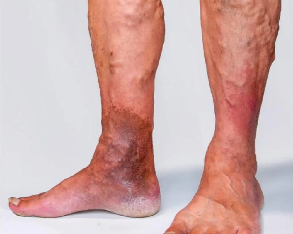 Busted Varicose Vein in Leg: Causes, Symptoms, and treatment Symptoms of a Burst Varicose Vein