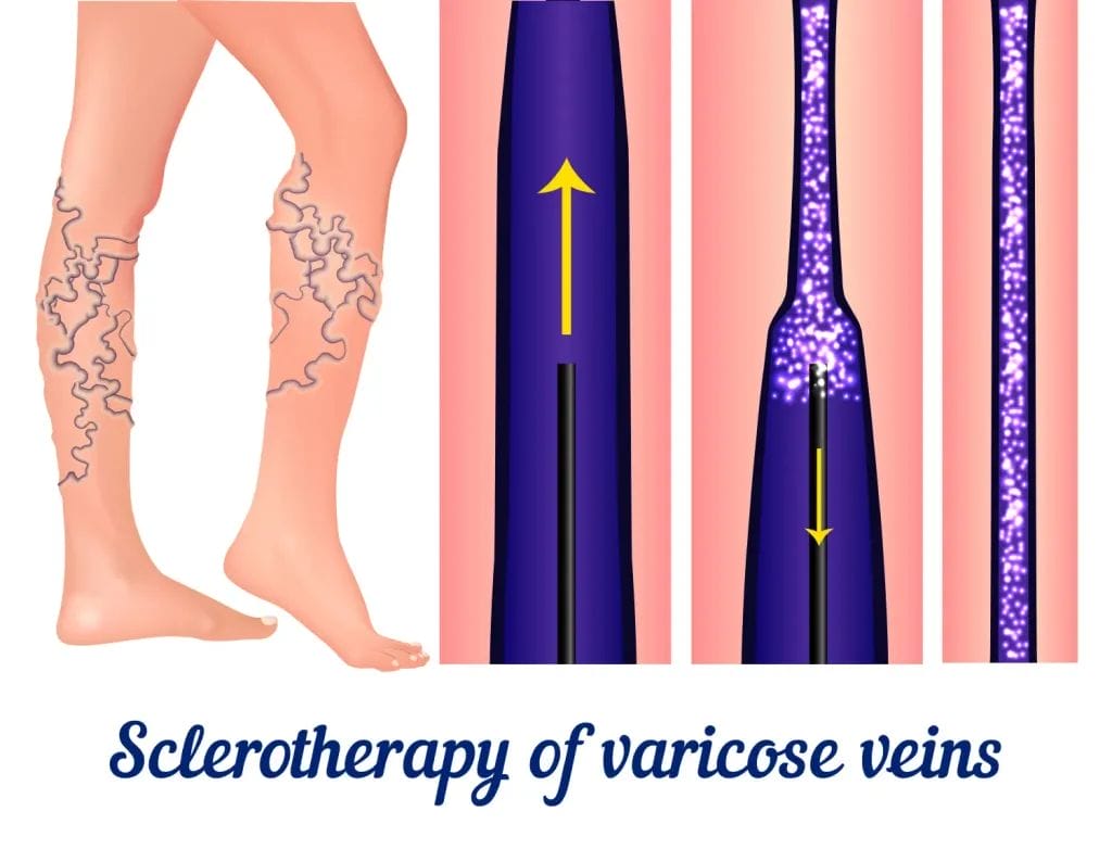 Recovery from Varicose Vein Surgery: How to Heal Faster ? Types of Varicose Vein Surgery & Their Recovery Timelines
