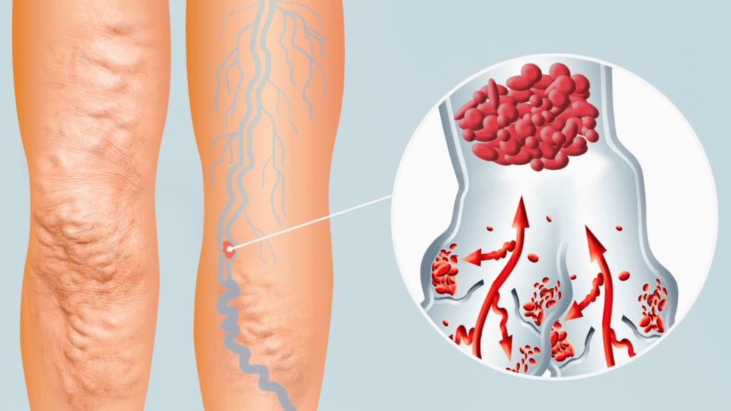 blood clots in foot: Symptoms, Risks and When to Seek Help What are blood clots in foot